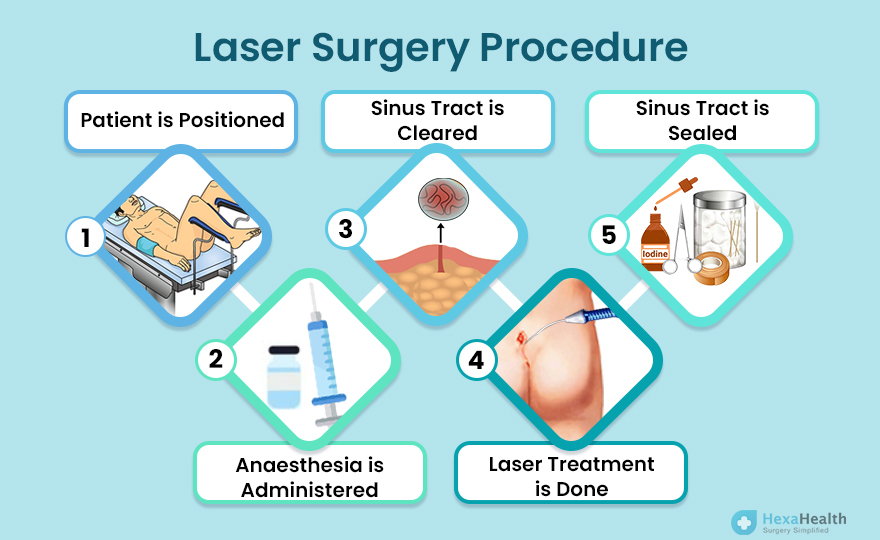 Laser Surgery Procedure